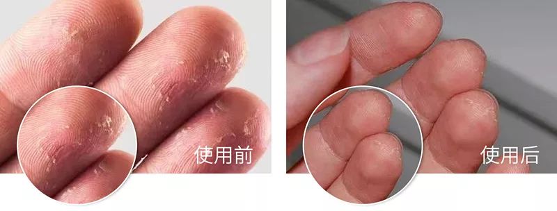 凤凰网梧桐汇商城|皮肤干痒、开裂、脱皮?用它抹一抹,立马见效