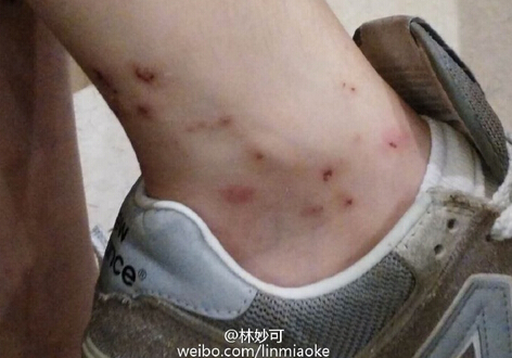 林妙可被毒虫咬伤 痘状脓疮凸起伤痕累累粉丝出妙招 ...