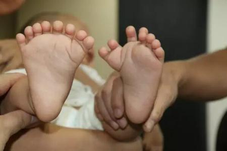 男婴长31个手指脚趾 指头都呈对称状态(图)