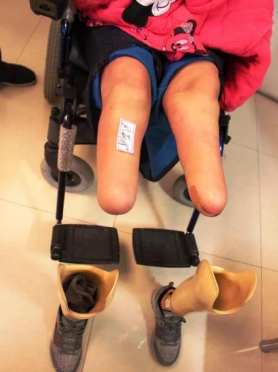 高二女生被强奸后遭二次抛弃 双目失明双腿截肢