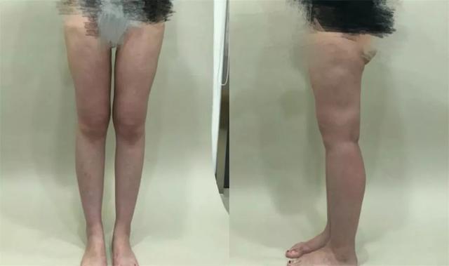 23岁女子花1万5做腿部吸脂术 半年后腿上全是坑