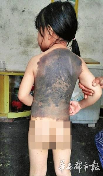 玲玲的背部为黑色