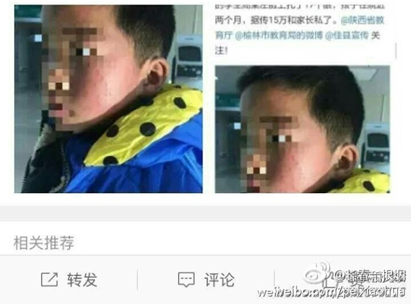 微博网友@漂西安 发布消息称，陕西佳县一校长拿蓝色的圆珠笔在孩子脸上扎了17个眼。  本文图片均为@漂西安 图