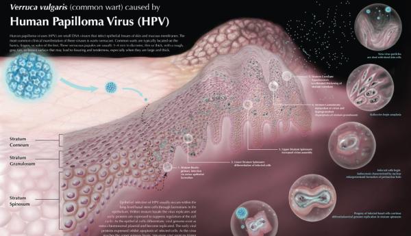 预防宫颈癌的HPV疫苗被批准进入中国,你打不打?
