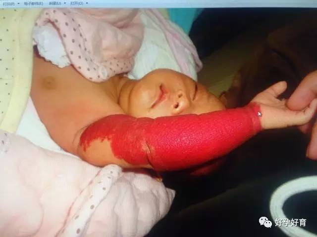 杭州一刚出生10天的宝宝，一只手臂竟全变鲜红色…