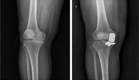 膝关节置换医院排名_膝关节置换图片(3)