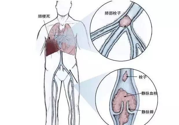 这个 隐蔽杀手 是中国城乡居民第一位死亡原因