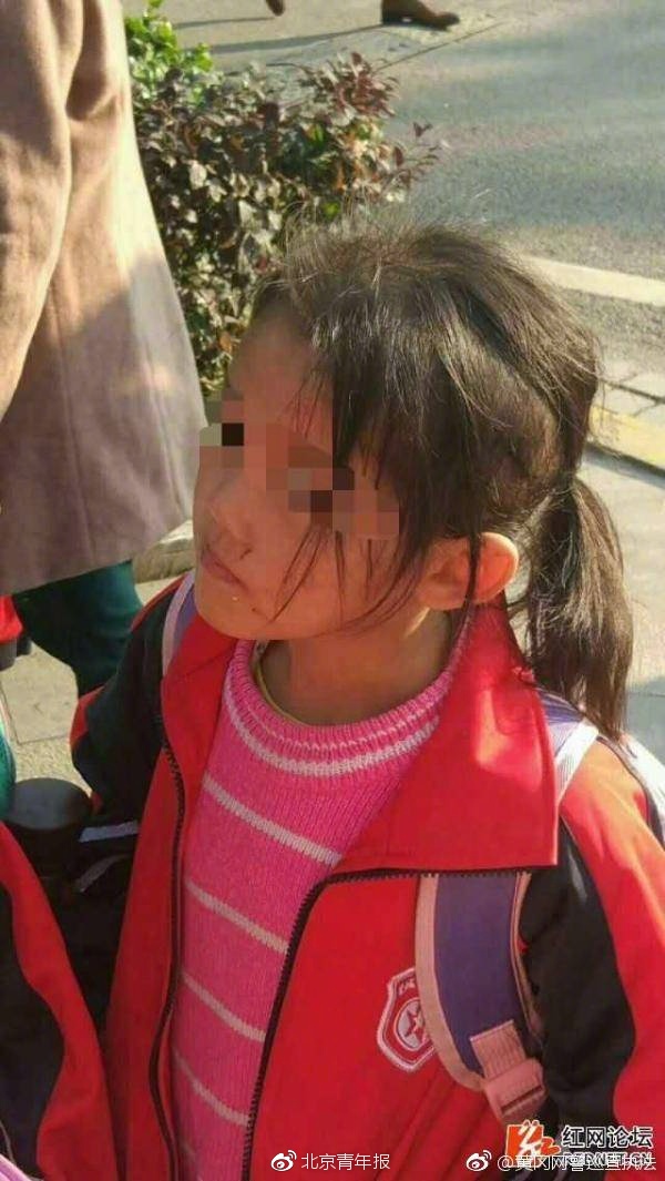 湖南6岁女童遭生母虐待 嫌疑人被刑拘