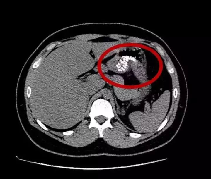 杭州16岁男孩肚子痛，CT片吓坏众人：胃里一堆“白点点”
