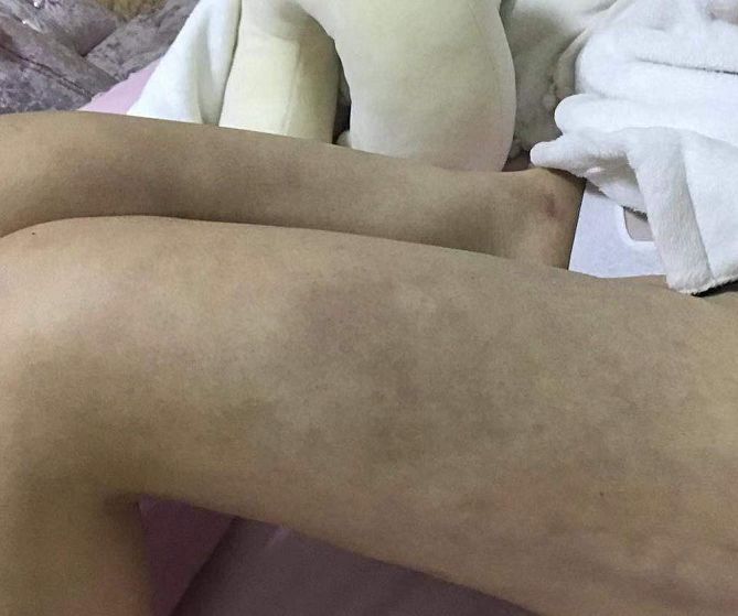 女子在南昌亚太医疗美容医院做抽脂手术 腿疼凹陷淤青