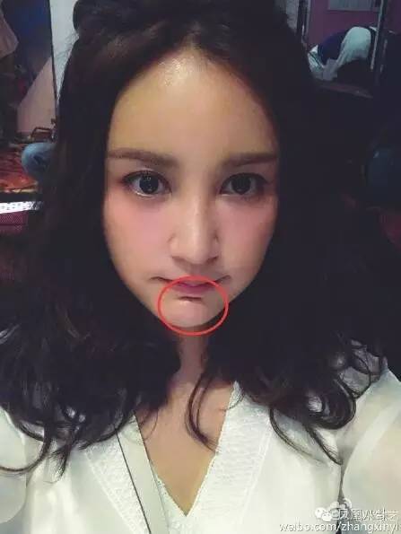 从张歆艺的下巴褶皱说起，女明星的下巴到底藏了什么秘密？