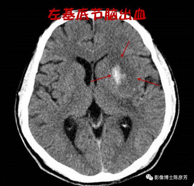 左基底节脑出血八上述这些亚临床疾病的病变还不足以引起症状,因此