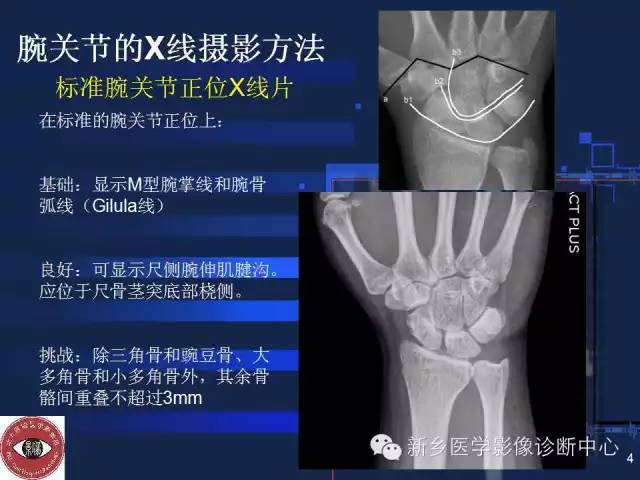 腕关节x线摄影基础