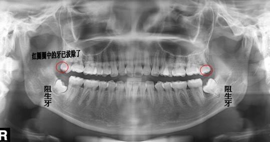 拔智齿有多痛苦?阻生智齿拔除步骤!