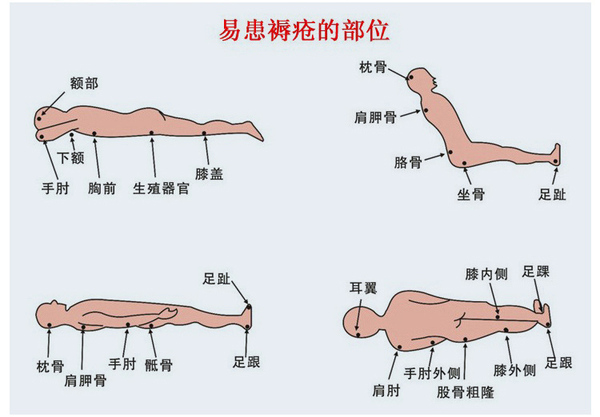 多发生于受压部位,如骶尾骨部,髋部,足跟,肩胛下等骨突出的地方.
