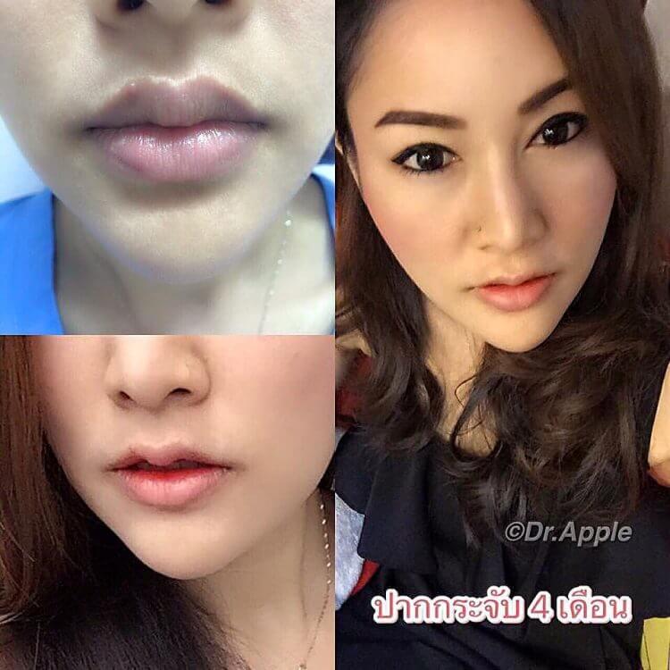 泰国女生整唇失控，痊愈后的古怪嘴型连医生都头痛啊