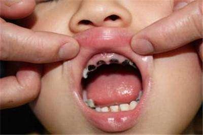 为什么小孩子的牙齿更容易烂