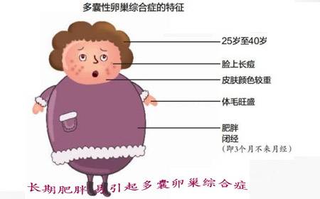 肥胖会引起"多囊卵巢综合症不孕"吗?怎么治?_凤凰资讯