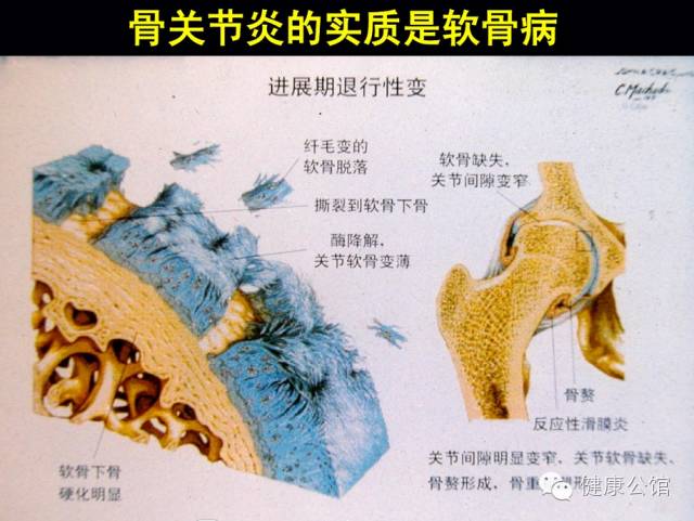 氨糖软骨素与骨关节炎病理关系