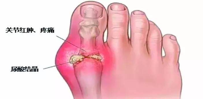 痛风占总人口比例_痛风的症状图片