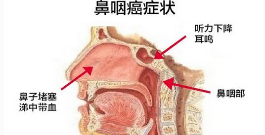 扬州30岁奶爸喉咙疼、鼻涕带血,一查竟是鼻咽