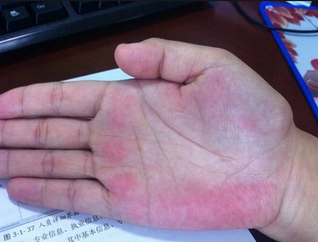 小测试:手掌这里发红,可能是肝脏出了问题!