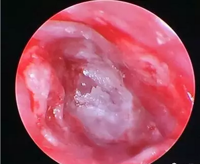 惊呆!浙江一5岁男孩掏颗耳屎花了5000块钱!还