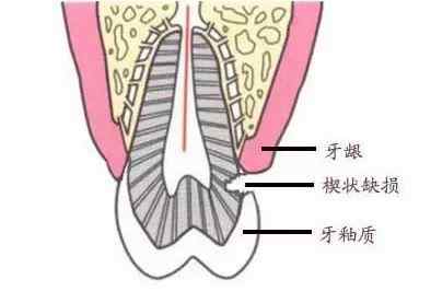 你的牙齿快被刷断了!