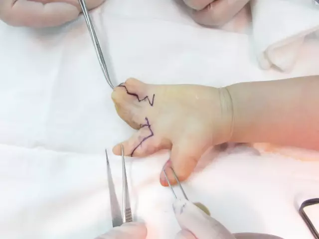 女婴天生16根手指全球罕见 医生4次手术后她能端碗吃饭了