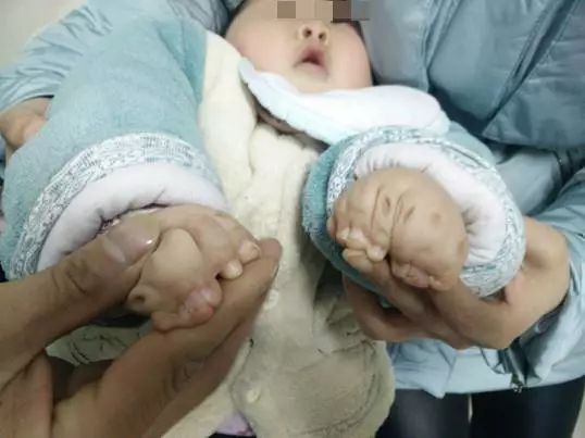 女婴天生16根手指全球罕见 医生4次手术后她能端碗吃饭了