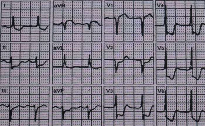 19个图例 教你掌握心电图阅读及诊断技巧