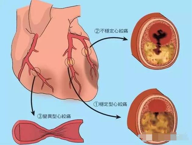 26岁小伙深夜心肌梗塞,救护车刚送到急诊室,人就没了!