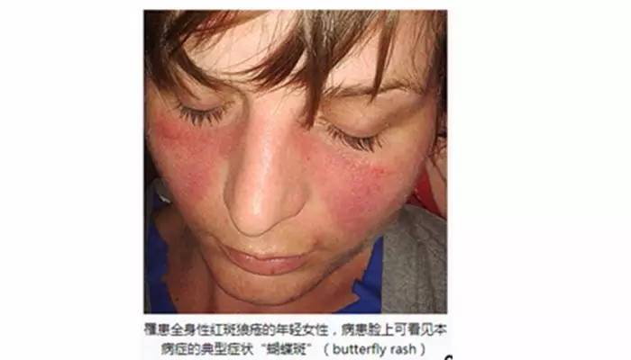 红斑狼疮一定是身上长红斑吗?未必!