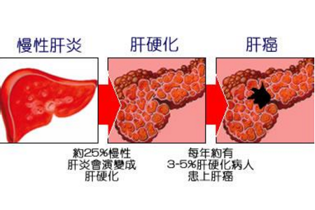 肝硬化!肝癌!教你如何看懂肝功能化验单?