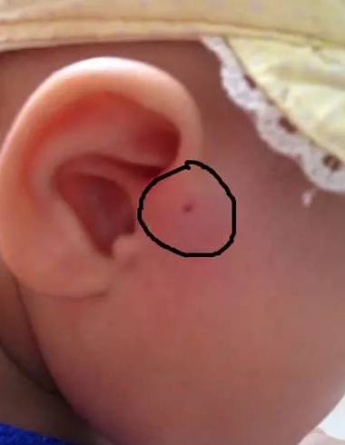 注意！你家宝宝耳朵上有这小孔吗？如果有就要小心了！
