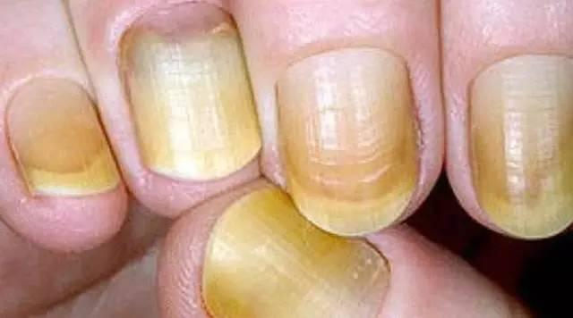 看指甲,就能知道有没有生病?