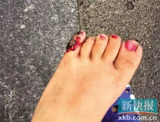 被电梯夹住 两岁男童正佳广场乘扶梯脚趾骨折