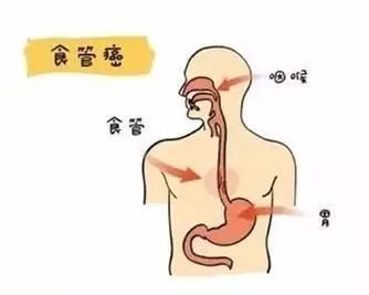 形成巨大的食管—主气管瘘,患者一旦进食,喝水,不能正常通过食道