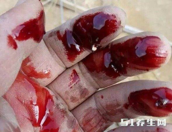 动脉出血