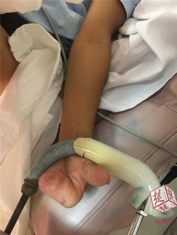 武汉四肢残疾孕妇顺产生下5.2斤男婴,产科专家为她感动