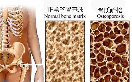 营养界限:骨质疏松的膳食营养治疗