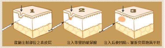 注射部位图.jpg
