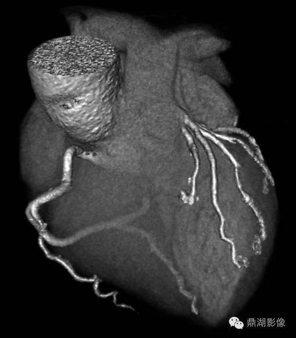 cta冠脉解剖(必点收藏)