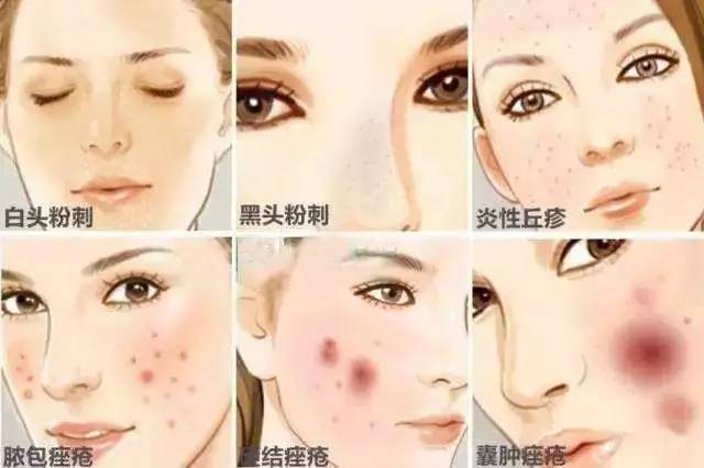 但如果过了青春期你还在长痘,那么就要注意了.