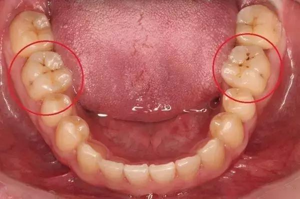 小朋友吃多了糖,牙齿里真的会长虫吗?怎么让它不长虫呢?