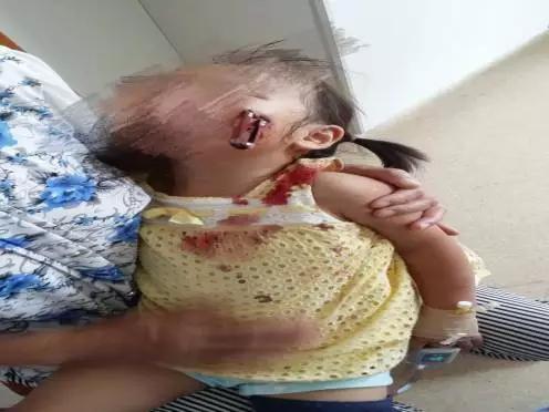 杭州一3岁女孩拿剪刀奔跑玩耍,不小心摔倒结果刺入面部