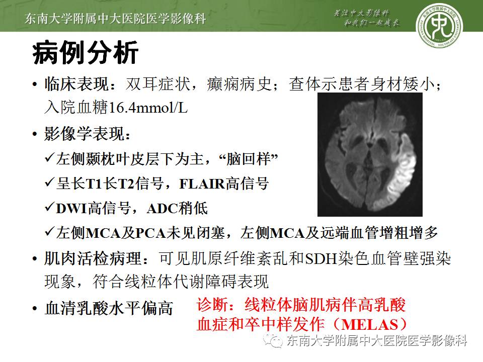 神经| 线粒体脑肌病