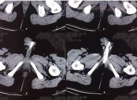 医生把6岁宝宝的尿道切开后傻眼了,他竟然把那么多东西塞了进去