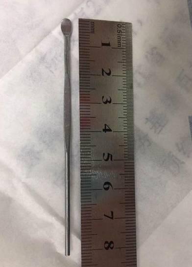 医生把6岁宝宝的尿道切开后傻眼了,他竟然把那么多东西塞了进去