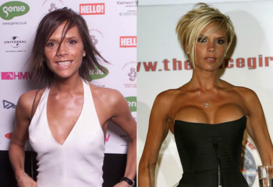 Victoria-Beckham-before-and-after-plastic-surgery-7